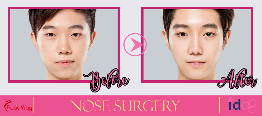Patient Testimonial Nose Surgery in Seoul, South Korea