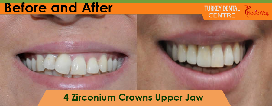 Before and after Zirconium crowns procedure in Turkey