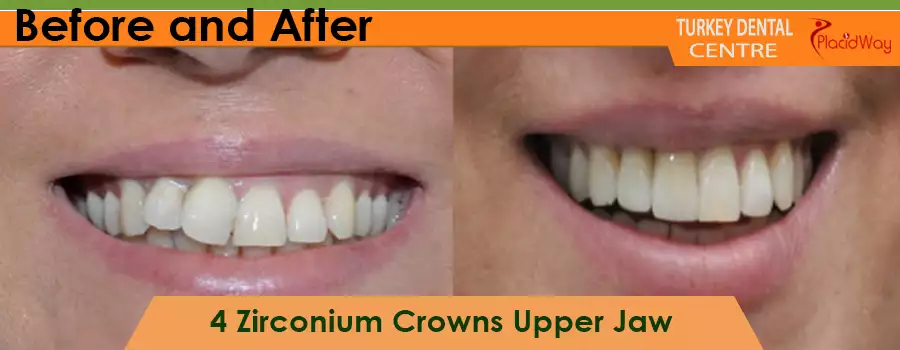 Before and After Zirconium Crowns in Turkey