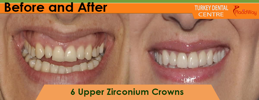 Patient Testimonial Zirconium Crowns Antalya Turkey