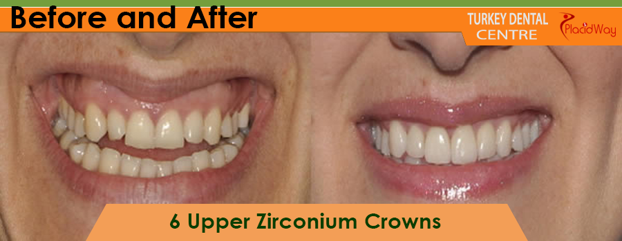 Patient Testimonial Zirconium Crowns Antalya Turkey