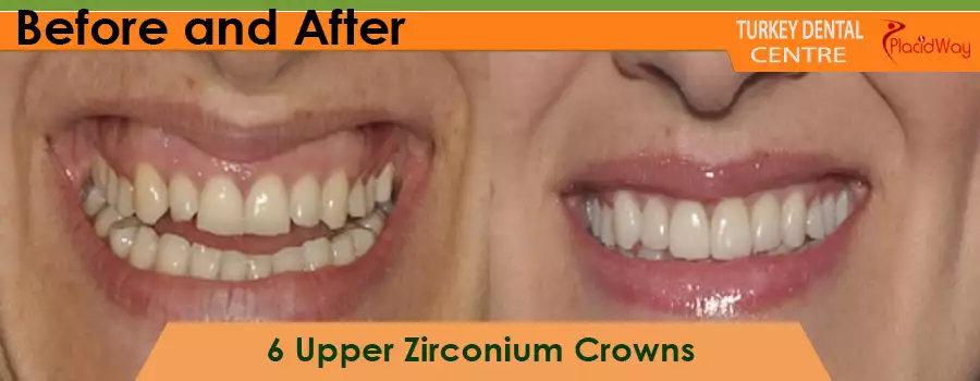 Before and After Zirconium Crowns in Turkey
