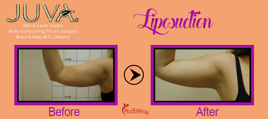 Before and After Liposuction Procedure New York
