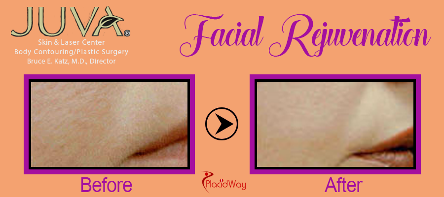 Before and After Facial Procedure New York