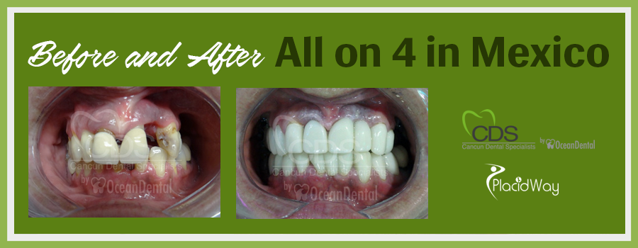 Before and After All-on-Four Dental Implants in Cancun, Mexico