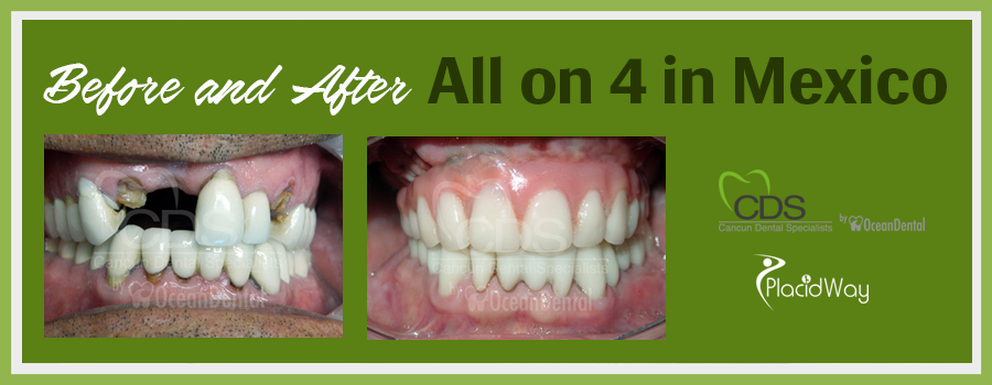 Patient Testimonials All-on-Four Dental Implants in Cancun, Mexico