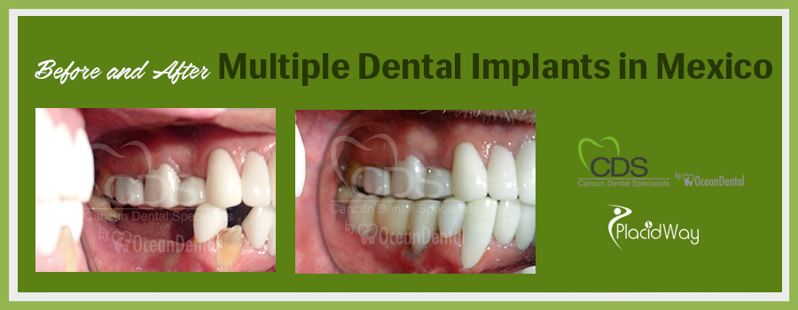 Before and After Multiple Dental Implants in Cancun, Mexico