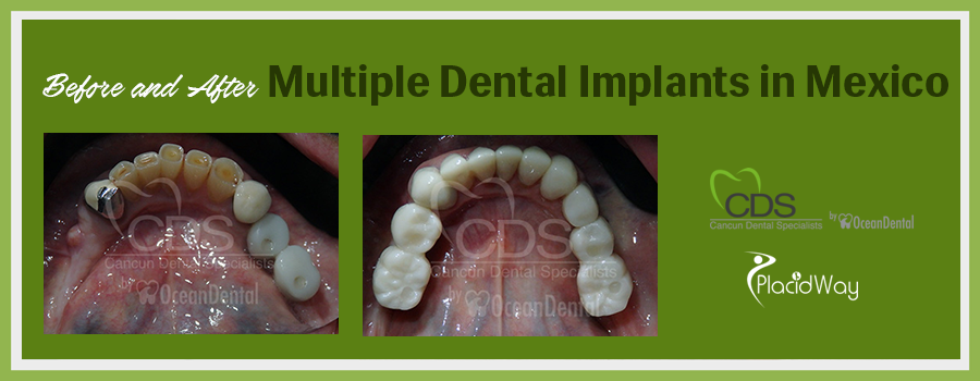 Patient Testimonials Multiple Dental Implants in Cancun, Mexico
