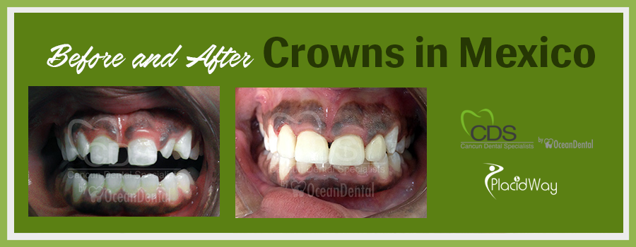 Before and After Dental Crowns in Cancun, Mexico