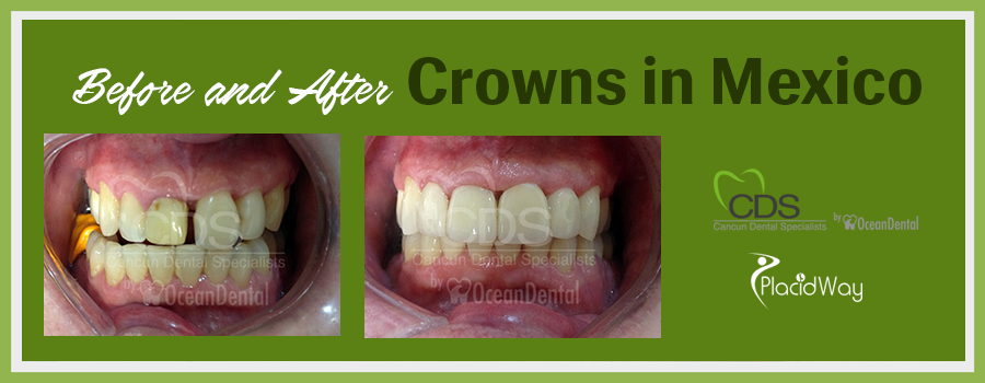 Patient Testimonials Dental Crowns in Cancun, Mexico