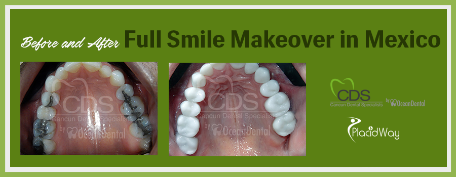 Before and After Full Smile Makeover in Cancun, Mexico