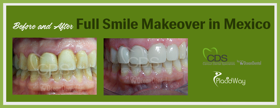 Patient Testimonials Full Smile Makeover in Cancun, Mexico