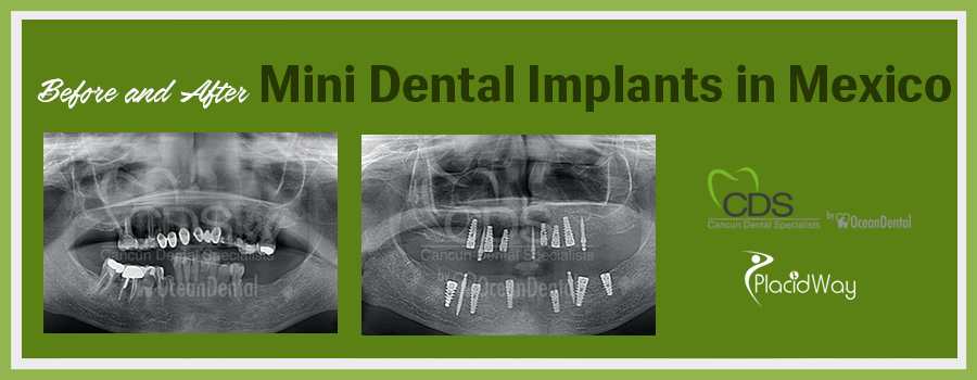 Before and After Mini Dental Implants in Cancun, Mexico