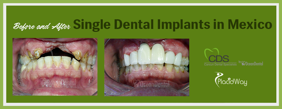 Before and After Single Dental Implants in Cancun, Mexico