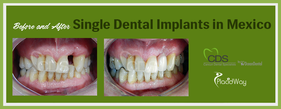 Patient Testimonials Single Dental Implants in Cancun, Mexico