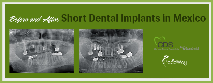 Before and After Short Dental Implants in Cancun, Mexico