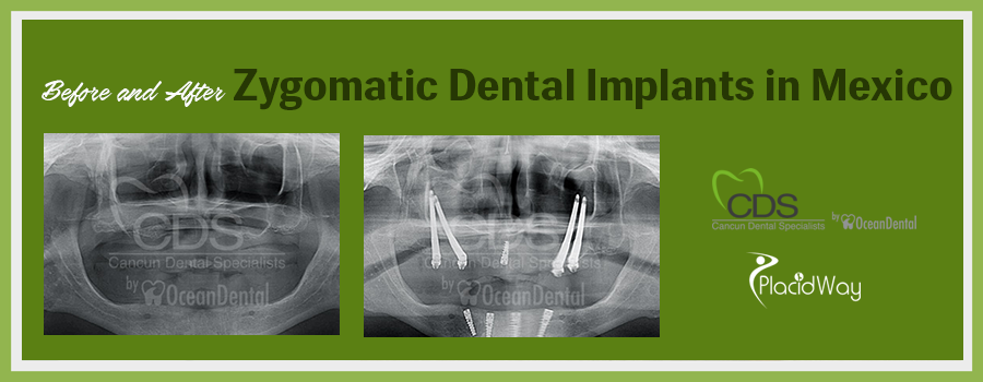 Before and After Zygomatic Dental Implants in Cancun, Mexico