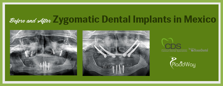 Patient Testimonials  Zygomatic Dental Implants in Cancun, Mexico