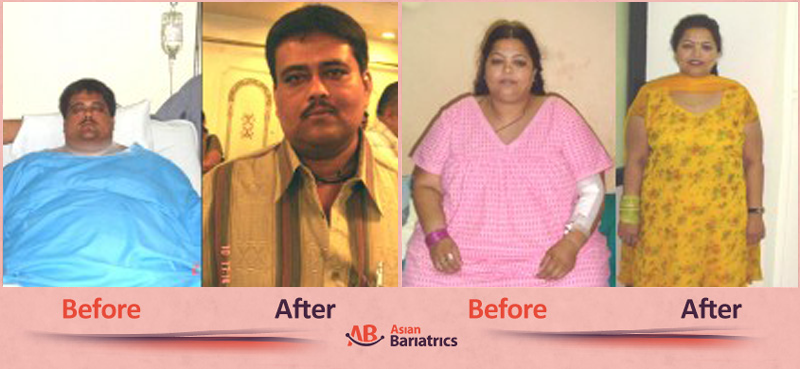 Patient Testimonials Weight Loss Surgery in Ahmedabad, India