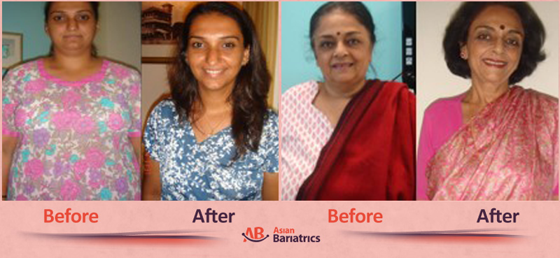 Patient Testimonials After Bariatric Surgery in Ahmedabad, India