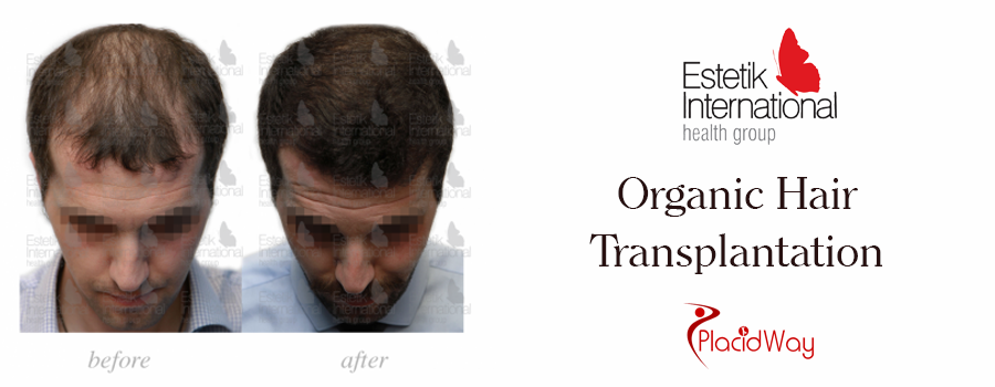 Picture Testimonial Hair Transplantation in Turkey