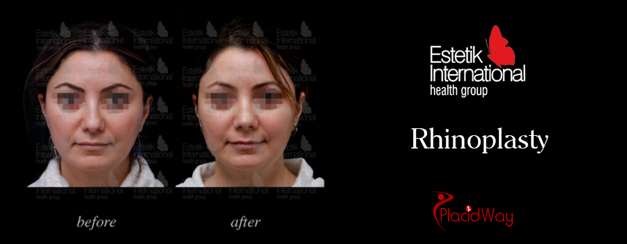 Before and After Rhinoplasty Turkey