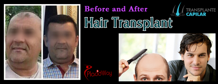 Before and After Hair Transplant Procedure in Turkey