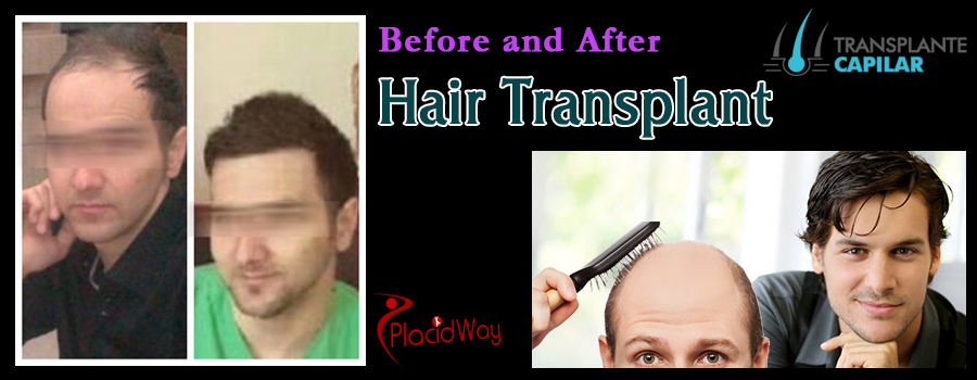 Before and After Pictures of Hair Transplant in Salud En Estambul Hair Transplant Clinic, Turkey