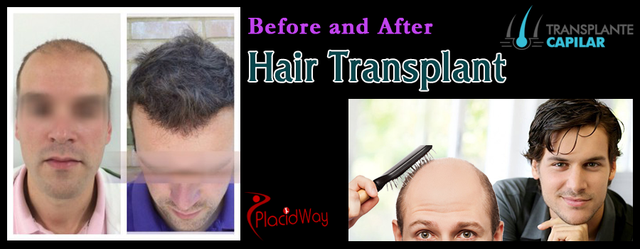 Hair Transplantation Before and After Images Istanbul Turkey