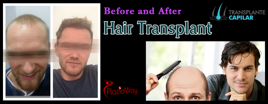 Before and After Hair Restoration in Turkey