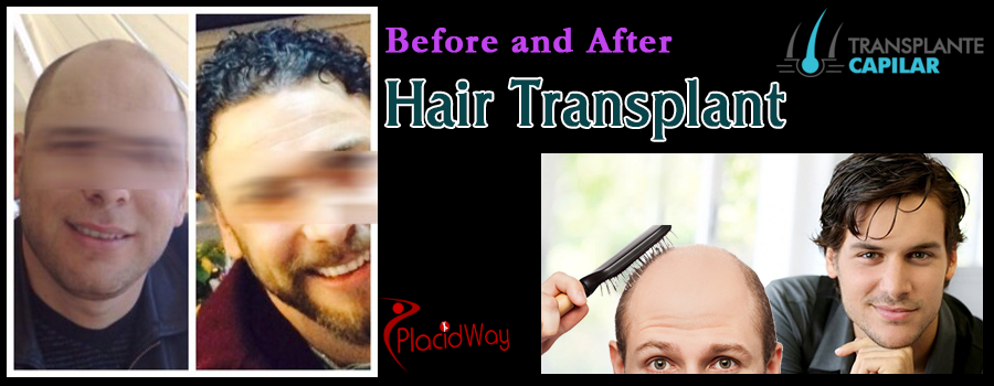 FUE Hair Transplant before and after - turkey