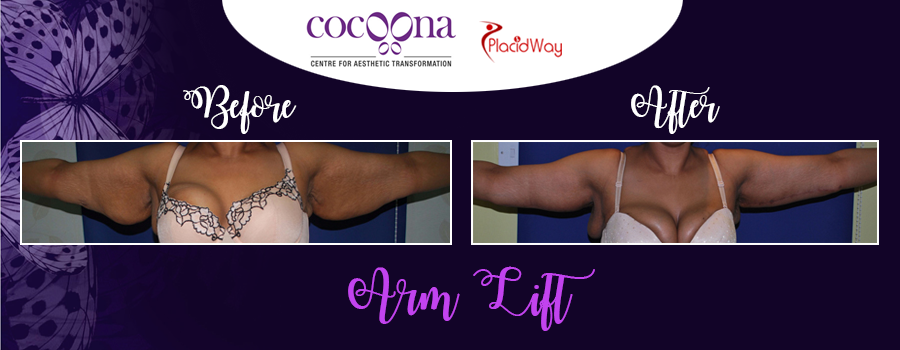 Before and After Images Arm Lift Surgery India