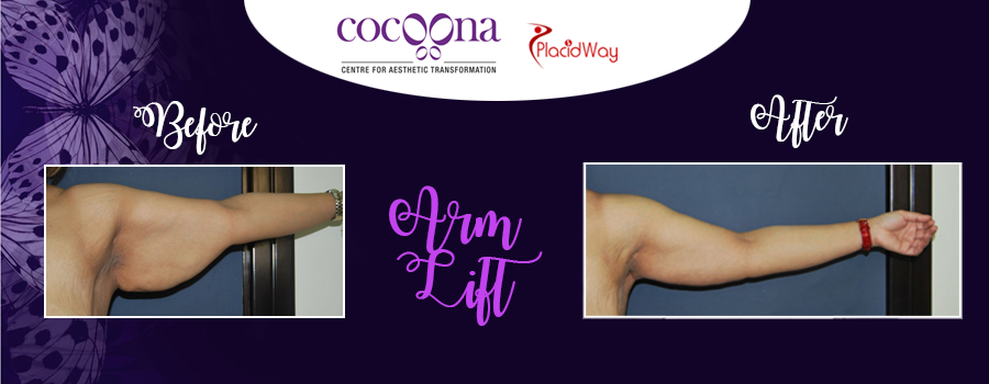 Arm Lift Plastic Surgery Cocoona Centre For Aesthetic Transformation India