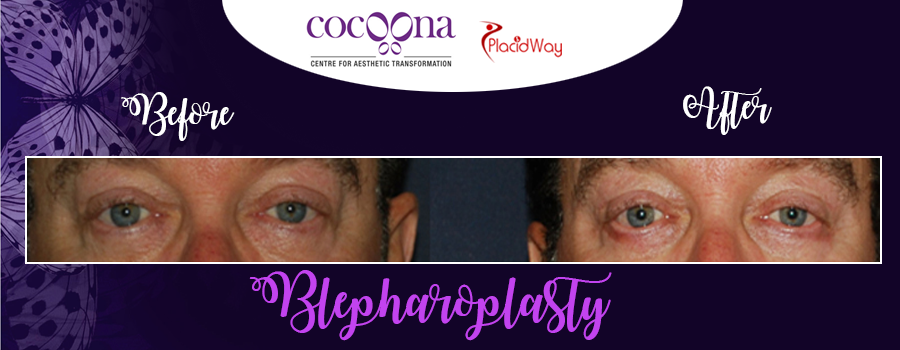 Before and After Images Blepharoplasty India