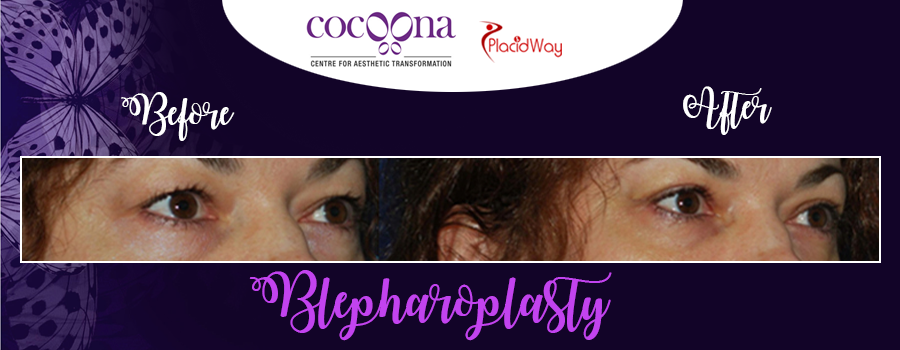 Blepharoplasty Plastic Surgery Cocoona Centre For Aesthetic Transformation India