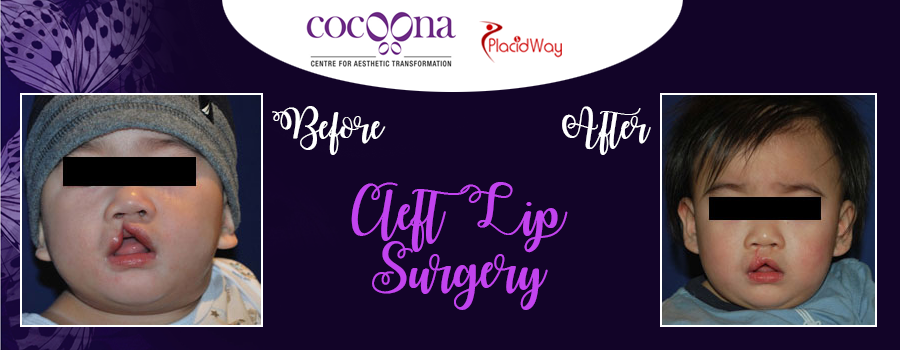 Cleft Lip Surgery Cocoona Centre For Aesthetic Transformation India