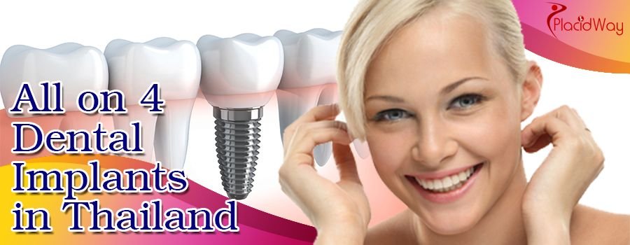 Best All on 4 Dental Implants in Thailand
