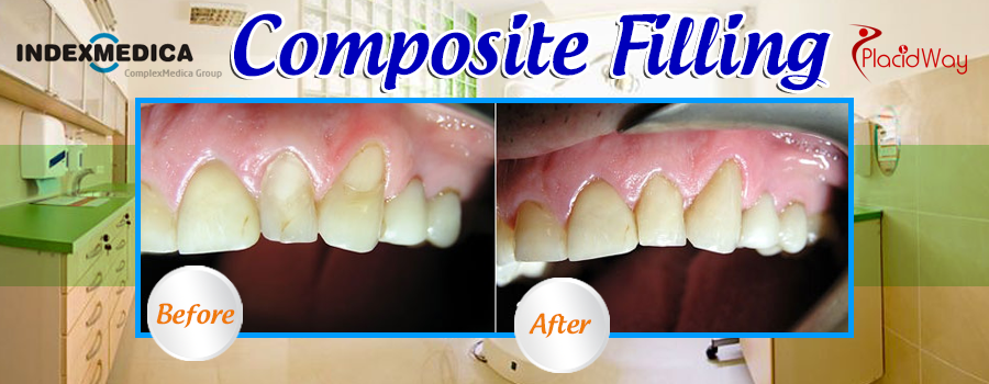 Composite Filling Before and After Results in Poland