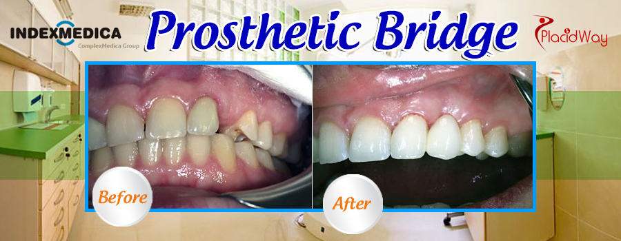 Prosthetic Bridge Before and After Results in Poland