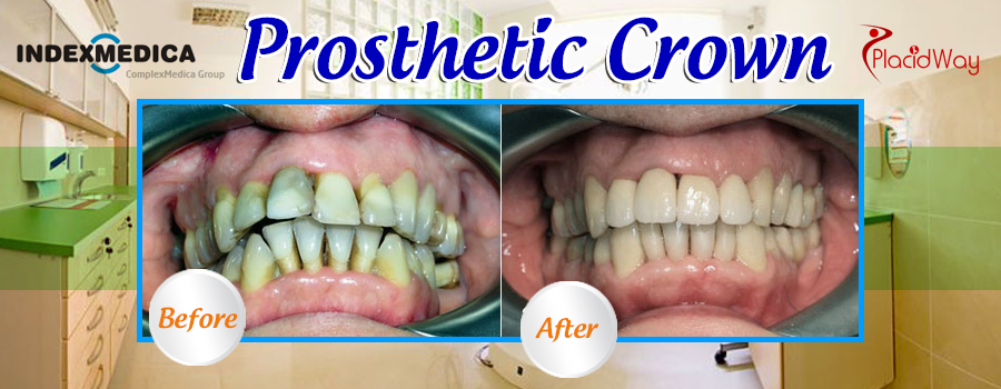 Before and After Prosthetic Crown in Krakow, Poland 