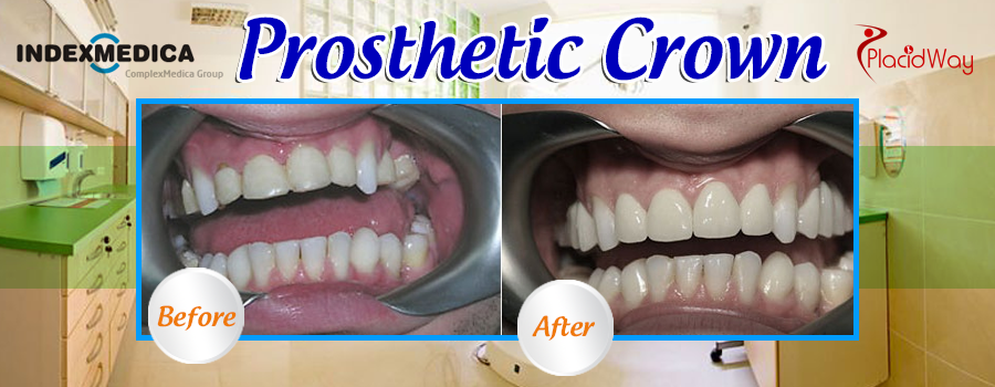 Prosthetic Crown Before and After Patient Testimonials in Poland