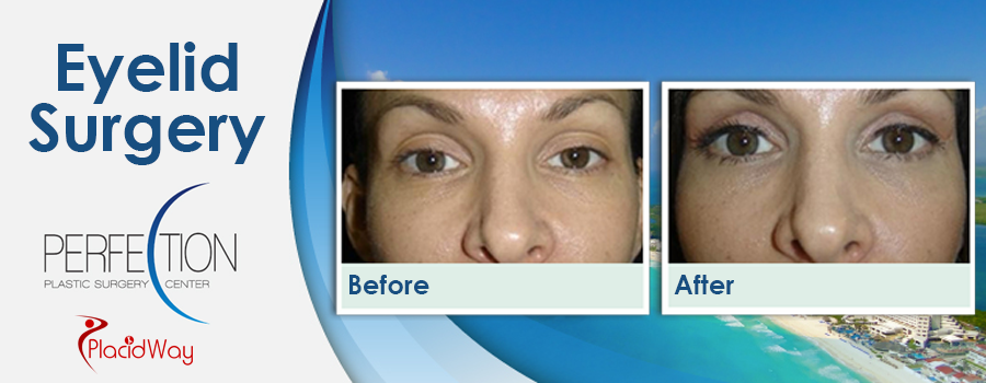 Before and After Eyelid Surgery in Mexico