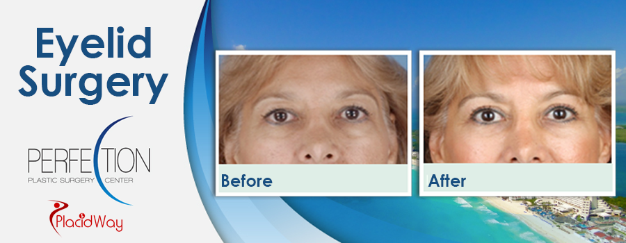 Before and After Cosmetic Procedure in Cancun Mexico