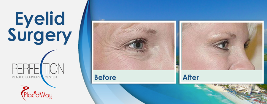 Patient Testimonials Eyelid Surgery in Cancun, Mexico