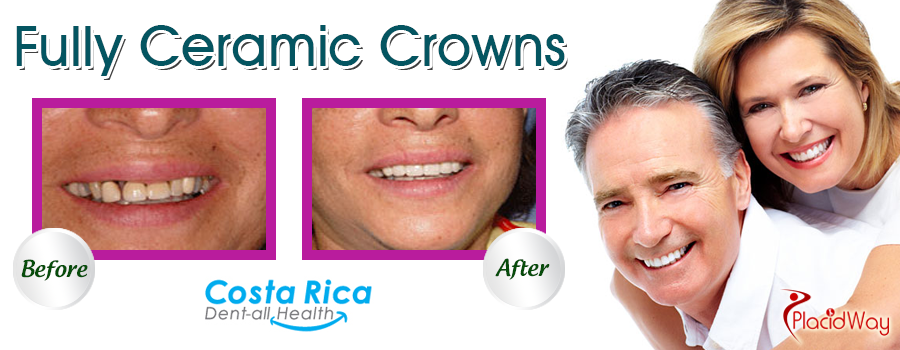 Before and After Ceramic Crowns in Costa Rica
