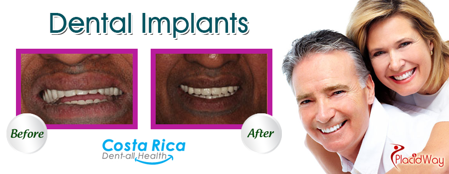 Dental Implants Before and After Results in Costa Rica