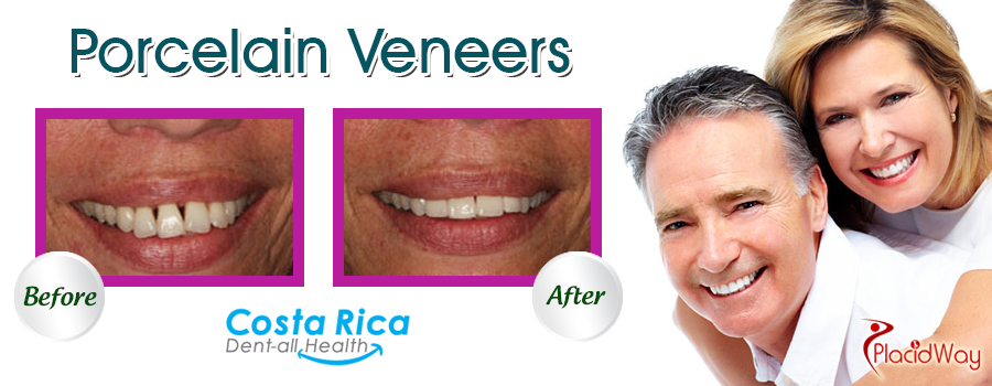 Before and After Porcelain Veneers in Costa Rica