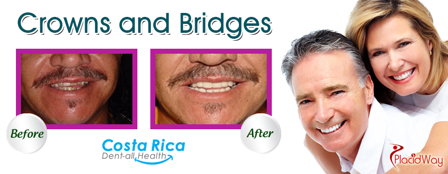 Before and After Crowns and Bridges in Costa Rica