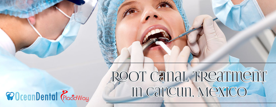 Affordable Root Canal Treatment Package in Cancun