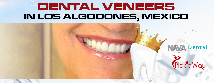 Dental Veneers in Los Algodones
